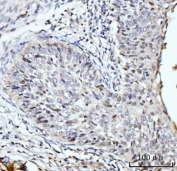 IHC staining of FFPE human lung cancer tissue with SBNO1 antibody. HIER: boil tissue sections in pH8 EDTA for 20 min and allow to cool before testing.