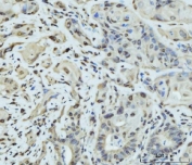 IHC staining of FFPE human gall bladder adenosquamous carcinoma tissue with Synaptonemal Complex Protein 3 antibody. HIER: boil tissue sections in pH8 EDTA for 20 min and allow to cool before testing.