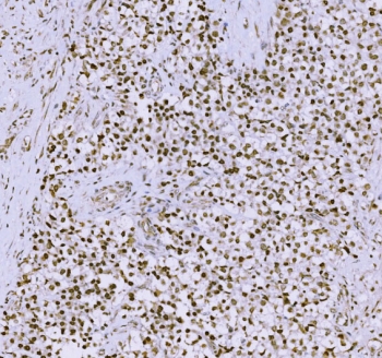 IHC staining of FFPE human testicular cancer tissue with Synaptonemal Complex Protein 3 antibody. HIER: boil tissue sections in pH8 EDTA for 20 min and allow to cool before testing.