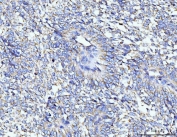IHC staining of FFPE human lung cancer tissue with TARS2 antibody. HIER: boil tissue sections in pH8 EDTA for 20 min and allow to cool before testing.