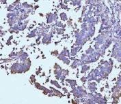 IHC staining of FFPE human colonic adenocarcinoma tissue with TARS2 antibody. HIER: boil tissue sections in pH8 EDTA for 20 min and allow to cool before testing.