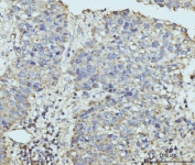 IHC staining of FFPE human liver cancer tissue with hUPF2 antibody. HIER: boil tissue sections in pH8 EDTA for 20 min and allow to cool before testing.