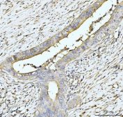IHC staining of FFPE human appendiceal adenocarcinoma tissue with hUPF2 antibody. HIER: boil tissue sections in pH8 EDTA for 20 min and allow to cool before testing.