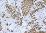 IHC staining of FFPE human breast cancer tissue with FLNB antibody. HIER: boil tissue sections in pH8 EDTA for 20 min and allow to cool before testing.