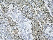 IHC staining of FFPE human lung cancer tissue with FLNB antibody. HIER: boil tissue sections in pH8 EDTA for 20 min and allow to cool before testing.