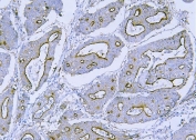 IHC staining of FFPE human rectal cancer tissue with FLNB antibody. HIER: boil tissue sections in pH8 EDTA for 20 min and allow to cool before testing.