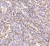 IHC staining of FFPE human lung cancer tissue with Epac1 antibody. HIER: boil tissue sections in pH8 EDTA for 20 min and allow to cool before testing.