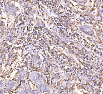 IHC staining of FFPE human lung cancer tissue with Epac1 antibody. HIER: boil tissue sections in pH8 EDTA for 20 min and allow to cool before testing.