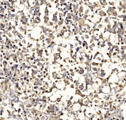 IHC staining of FFPE human pancreatic cancer tissue with Epac1 antibody. HIER: boil tissue sections in pH8 EDTA for 20 min and allow to cool before testing.