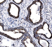IHC staining of FFPE human colon cancer tissue with SLC12A2 antibody. HIER: boil tissue sections in pH8 EDTA for 20 min and allow to cool before testing.