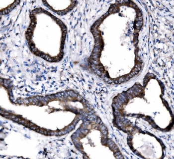 IHC staining of FFPE human colon cancer tissue with SLC12A2 antibody. HIER: boil tissue sections in pH8 EDTA for 20 min and allow to cool before testing.