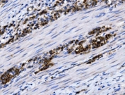 IHC staining of FFPE human rectal cancer tissue with SLC12A2 antibody. HIER: boil tissue sections in pH8 EDTA for 20 min and allow to cool before testing.