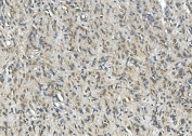 IHC staining of FFPE human glioma tissue with Synaptophysin antibody. HIER: boil tissue sections in pH8 EDTA for 20 min and allow to cool before testing.