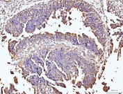 IHC staining of FFPE human colonic adenocarcinoma tissue with DUSP6 antibody. HIER: boil tissue sections in pH8 EDTA for 20 min and allow to cool before testing.