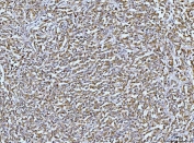 IHC staining of FFPE human lymphadenoma tissue with DUSP6 antibody. HIER: boil tissue sections in pH8 EDTA for 20 min and allow to cool before testing.