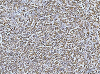 IHC staining of FFPE human lymphadenoma tissue with DUSP6 antibody. HIER: boil tissue sections in pH8 EDTA for 20 min and allow to cool before testing.