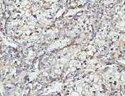 IHC staining of FFPE human liver cancer tissue with DUSP6 antibody. HIER: boil tissue sections in pH8 EDTA for 20 min and allow to cool before testing.