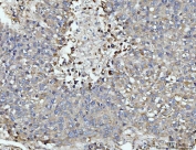 IHC staining of FFPE human liver cancer tissue with DUSP6 antibody. HIER: boil tissue sections in pH8 EDTA for 20 min and allow to cool before testing.