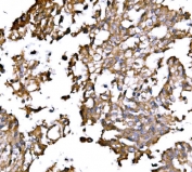 IHC staining of FFPE human laryngeal squamous cell carcinoma tissue with IRBIT antibody. HIER: boil tissue sections in pH8 EDTA for 20 min and allow to cool before testing.