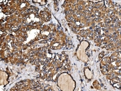 IHC staining of FFPE human thyroid papillary carcinoma tissue with IRBIT antibody. HIER: boil tissue sections in pH8 EDTA for 20 min and allow to cool before testing.