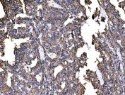 IHC staining of FFPE human Hashimoto's thyroiditis tissue with IRBIT antibody. HIER: boil tissue sections in pH8 EDTA for 20 min and allow to cool before testing.