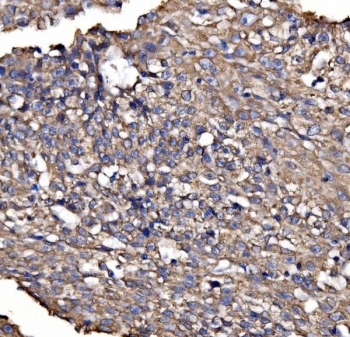 IHC staining of FFPE human laryngeal carcinoma tissue with BRSK1 antibody. HIER: boil tissue sections in pH8 EDTA for 20 min and allow to cool before testing.