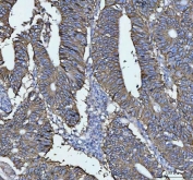 IHC staining of FFPE human rectal cancer tissue with CDH17 antibody. HIER: boil tissue sections in pH8 EDTA for 20 min and allow to cool before testing.