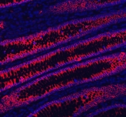 Immunofluorescent staining of FFPE human intestinal cancer tissue with CDH17 antibody (red) and DAPI nuclear stain (blue). HIER: boil tissue sections in pH8 EDTA for 20 min and allow to cool before testing.