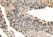 IHC staining of FFPE human liver cancer tissue with CPSF6 antibody. HIER: boil tissue sections in pH8 EDTA for 20 min and allow to cool before testing.