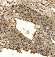 IHC staining of FFPE human liver cancer tissue with CPSF6 antibody. HIER: boil tissue sections in pH8 EDTA for 20 min and allow to cool before testing.