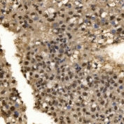 IHC staining of FFPE human liver cancer tissue with CPSF6 antibody. HIER: boil tissue sections in pH8 EDTA for 20 min and allow to cool before testing.