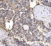 IHC staining of FFPE human Hashimoto's thyroiditis tissue with CPSF6 antibody. HIER: boil tissue sections in pH8 EDTA for 20 min and allow to cool before testing.
