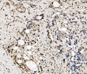IHC staining of FFPE human bladder adenosquamous carcinoma tissue with CPSF6 antibody. HIER: boil tissue sections in pH8 EDTA for 20 min and allow to cool before testing.