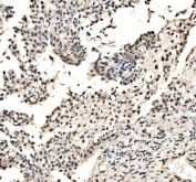 IHC staining of FFPE human laryngeal squamous cell carcinoma tissue with CPSF6 antibody. HIER: boil tissue sections in pH8 EDTA for 20 min and allow to cool before testing.