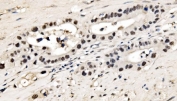 IHC staining of FFPE human appendiceal adenocarcinoma tissue with CPSF6 antibody. HIER: boil tissue sections in pH8 EDTA for 20 min and allow to cool before testing.
