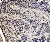 IHC staining of FFPE human lung cancer tissue with CPSF6 antibody. HIER: boil tissue sections in pH8 EDTA for 20 min and allow to cool before testing.