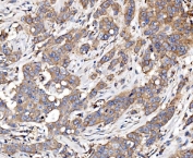 IHC staining of FFPE human breast cancer tissue with Glycogen synthase 1 antibody. HIER: boil tissue sections in pH8 EDTA for 20 min and allow to cool before testing.