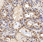 IHC staining of FFPE human renal clear cell carcinoma tissue with Glycogen synthase 1 antibody. HIER: boil tissue sections in pH8 EDTA for 20 min and allow to cool before testing.