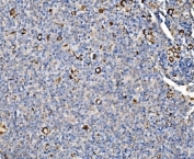 IHC staining of FFPE human lymphoma tissue with Glycogen synthase 1 antibody. HIER: boil tissue sections in pH8 EDTA for 20 min and allow to cool before testing.