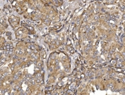 IHC staining of FFPE human thyroid papillary carcinoma tissue with Pyrin antibody. HIER: boil tissue sections in pH8 EDTA for 20 min and allow to cool before testing.