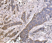 IHC staining of FFPE human lung cancer tissue with MLXIP antibody. HIER: boil tissue sections in pH8 EDTA for 20 min and allow to cool before testing.