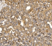 IHC staining of FFPE human thyroid papillary carcinoma tissue with MLXIP antibody. HIER: boil tissue sections in pH8 EDTA for 20 min and allow to cool before testing.