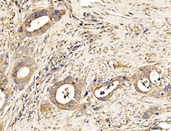 IHC staining of FFPE human appendiceal adenocarcinoma tissue with MLXIP antibody. HIER: boil tissue sections in pH8 EDTA for 20 min and allow to cool before testing.