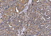 IHC staining of FFPE human thyroid papillary carcinoma tissue with MLXIP antibody. HIER: boil tissue sections in pH8 EDTA for 20 min and allow to cool before testing.