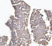 IHC staining of FFPE human laryngeal squamous cell carcinoma tissue with MLXIP antibody. HIER: boil tissue sections in pH8 EDTA for 20 min and allow to cool before testing.