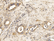 IHC staining of FFPE human appendiceal adenocarcinoma tissue with MLXIP antibody. HIER: boil tissue sections in pH8 EDTA for 20 min and allow to cool before testing.