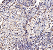 IHC staining of FFPE human lung cancer tissue with NDUFAF1 antibody. HIER: boil tissue sections in pH8 EDTA for 20 min and allow to cool before testing.