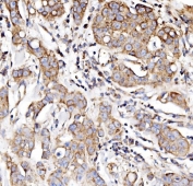 IHC staining of FFPE human breast cancer tissue with NDUFAF1 antibody. HIER: boil tissue sections in pH8 EDTA for 20 min and allow to cool before testing.