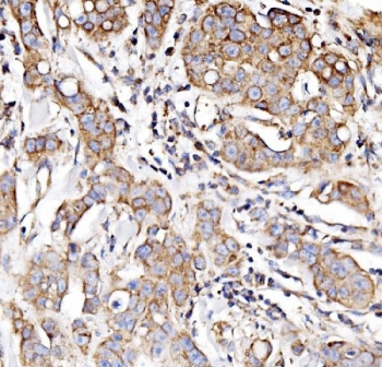 IHC staining of FFPE human breast cancer tissue with NDUFAF1 antibody. HIER: boil tissue sections in pH8 EDTA for 20 min and allow to cool before testing.