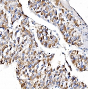 IHC staining of FFPE human liver cancer tissue with NDUFAF1 antibody. HIER: boil tissue sections in pH8 EDTA for 20 min and allow to cool before testing.